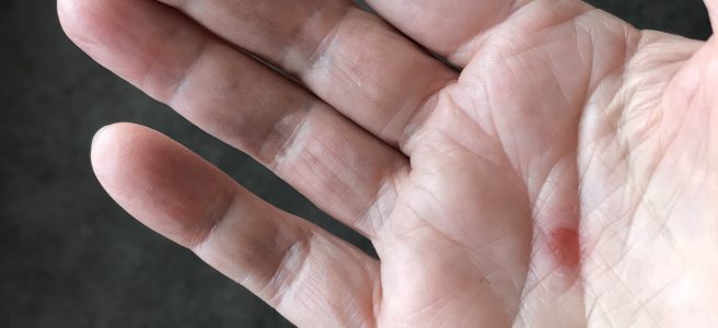 the open palm of a hand with a raw red blister in the centre of it